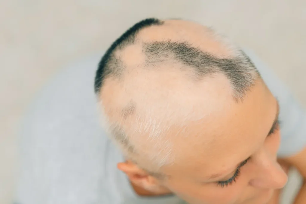 Alopecia And Skin Rash: Deadly Symptoms
