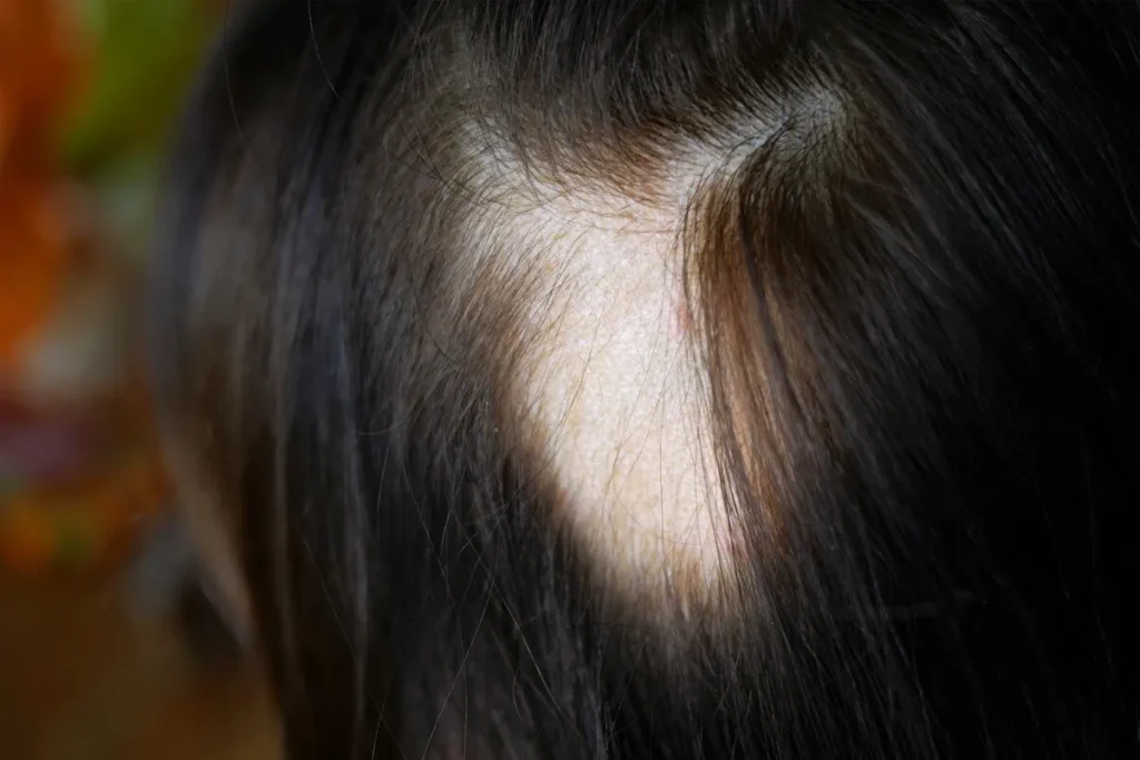 Alopecia And Skin Rash: Deadly Symptoms