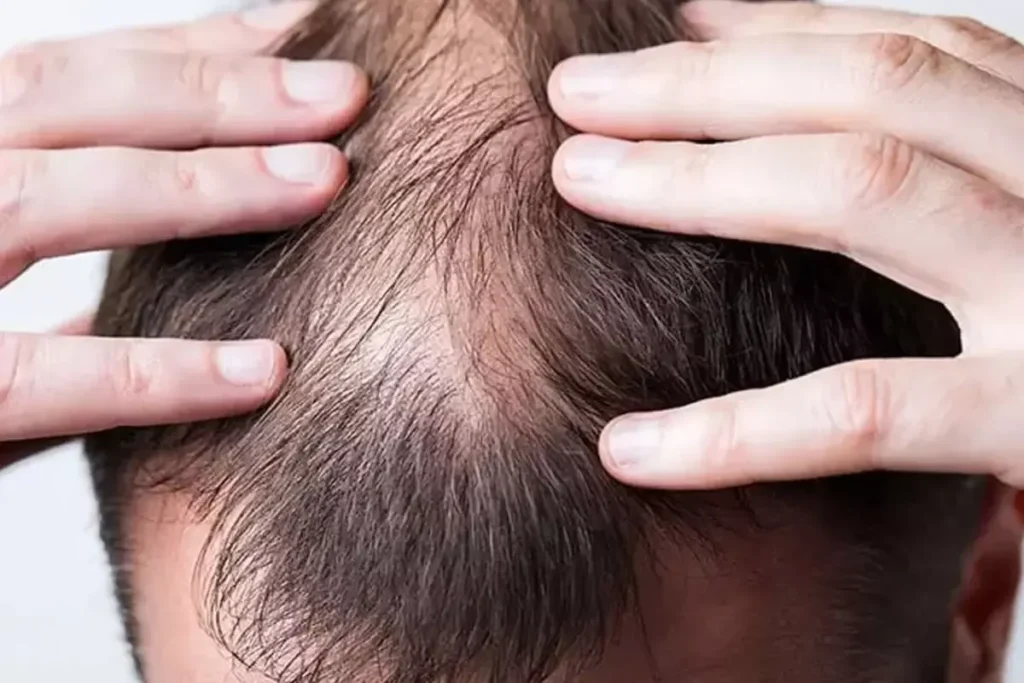 Alopecia Areata baardkuur: snelle resultaten