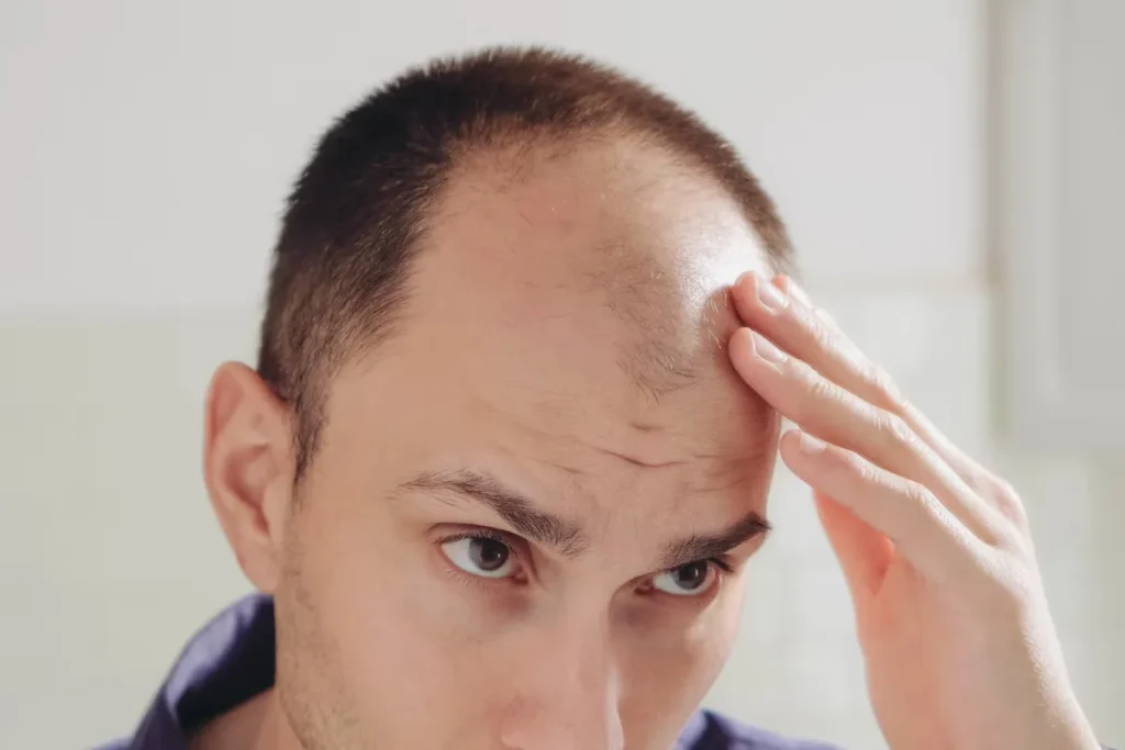 Alopecia Areata Diffuse Hair Loss Solutions