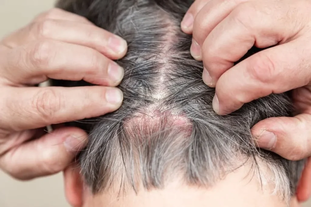 Understanding Alopecia Areata and Nail Involvement
