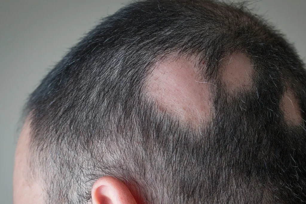 Alopecia Areata Hair Transplant: Expert View