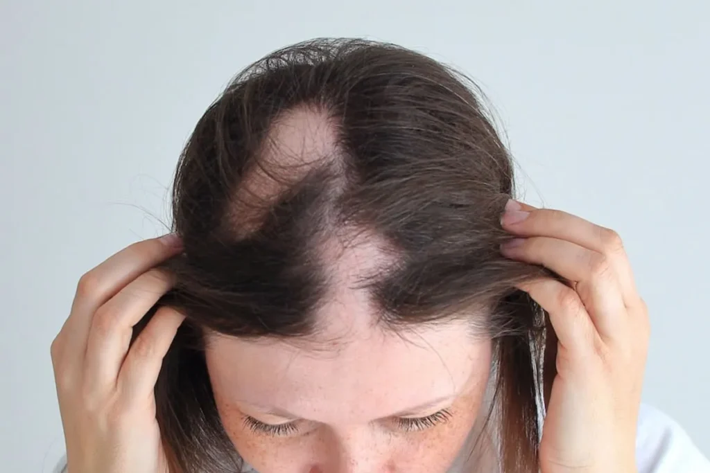 Understanding Alopecia Areata and Its Effects on Nails