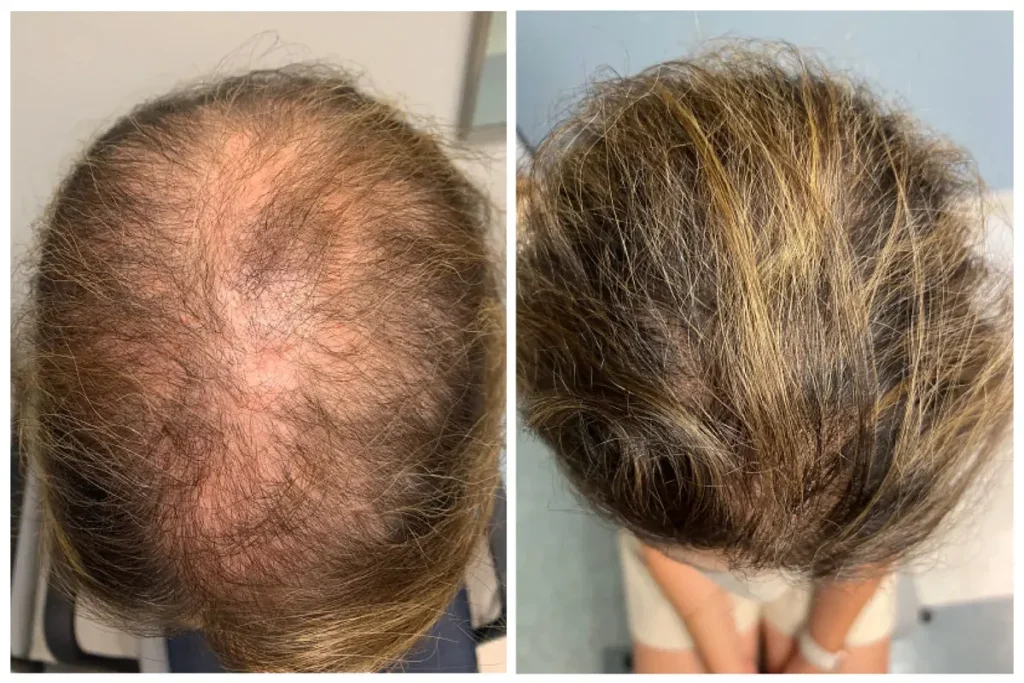 Alopecia Areata Topical: Best Cream Guide