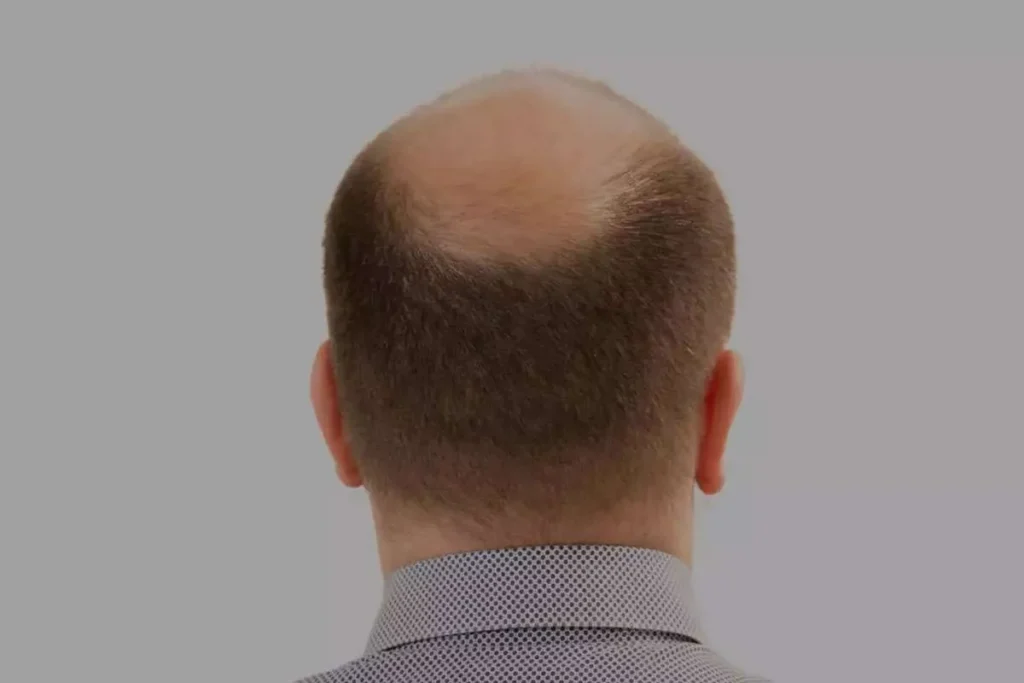 Understanding Alopecia Areata and Topical Steroid Treatment