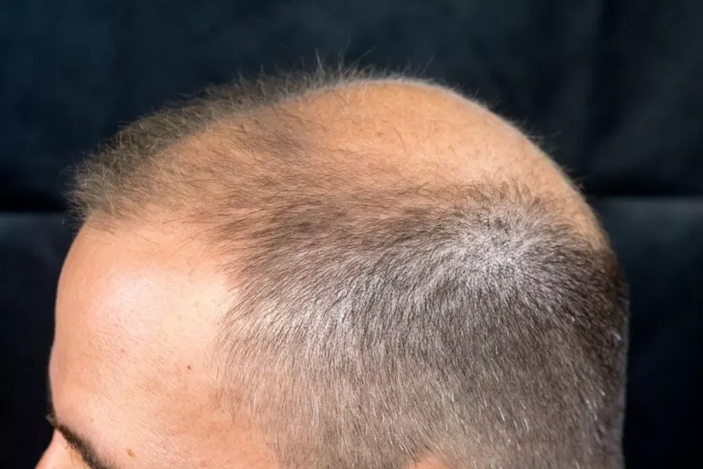 Alopecia Areata Totalis: Ultimate Cure Guide