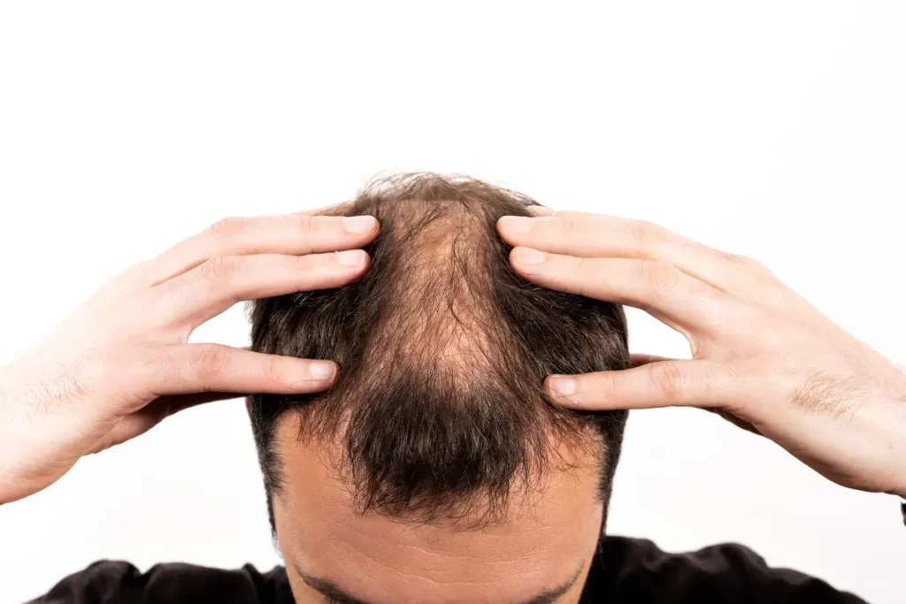 Traditional Alopecia Areata Treatments