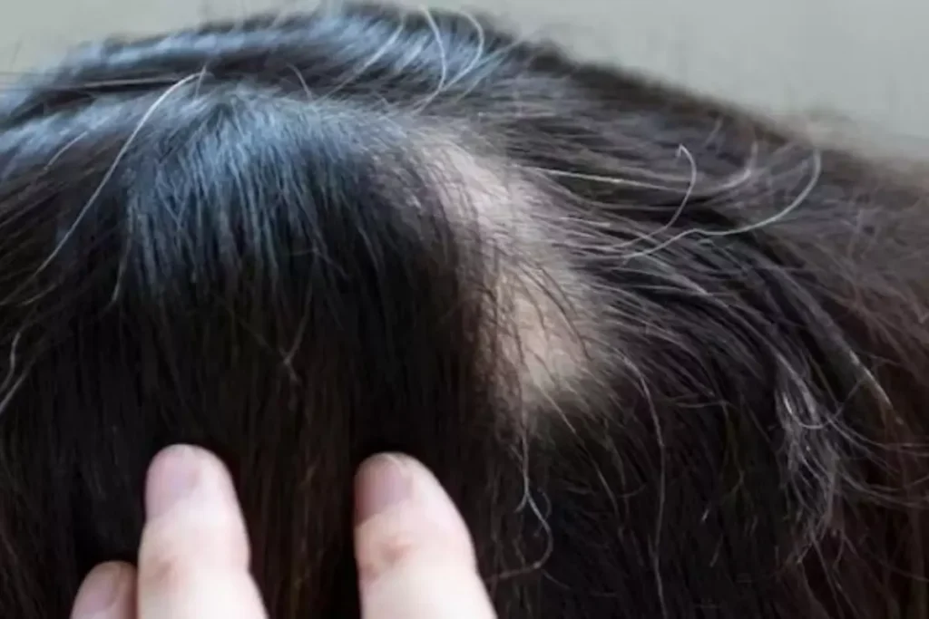 Alopecia Beard Treatment: Stop Facial Loss