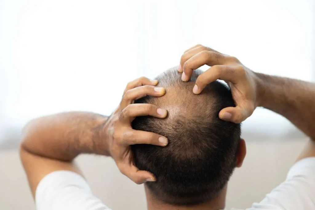 Understanding Alopecia Barbae