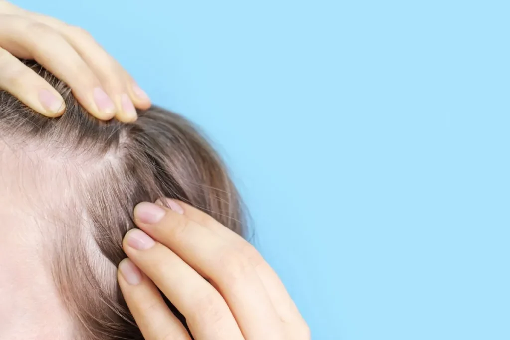 Alopecia Diffuse: Best Ways To Thicken Hair