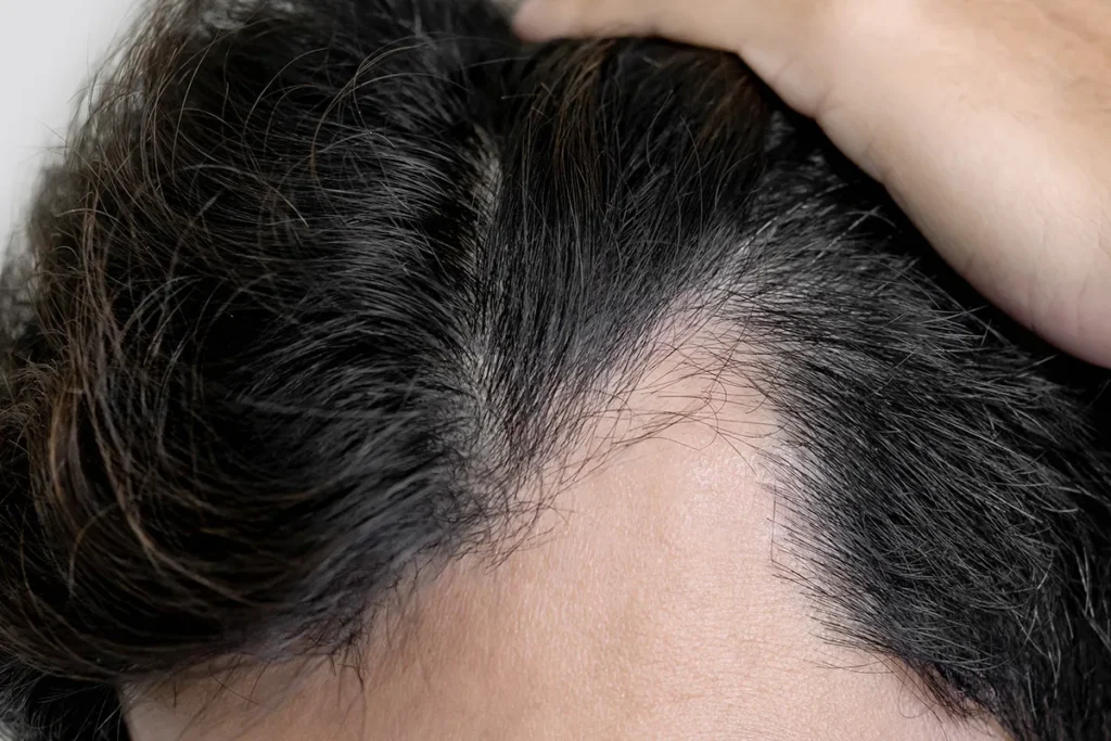 Understanding Diffuse Hair Loss