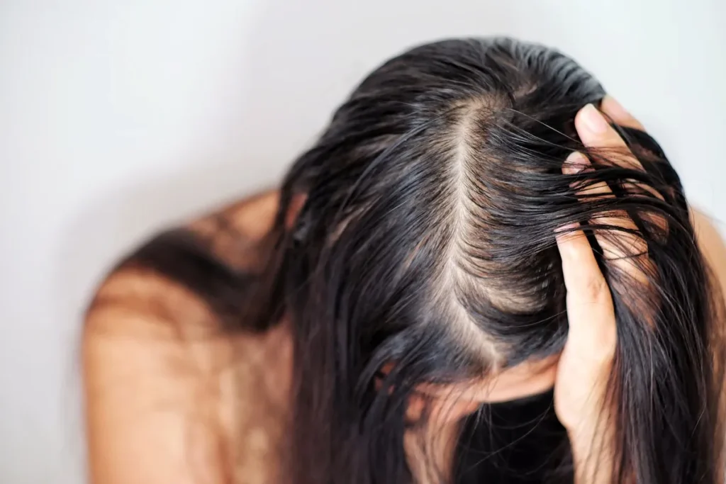 Causes of Alopecia Diffuse