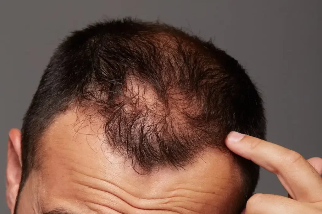 Alopecia Due To Stress: Effective Remedies