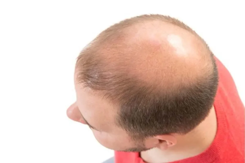 Understanding Alopecia Facial Hair Loss