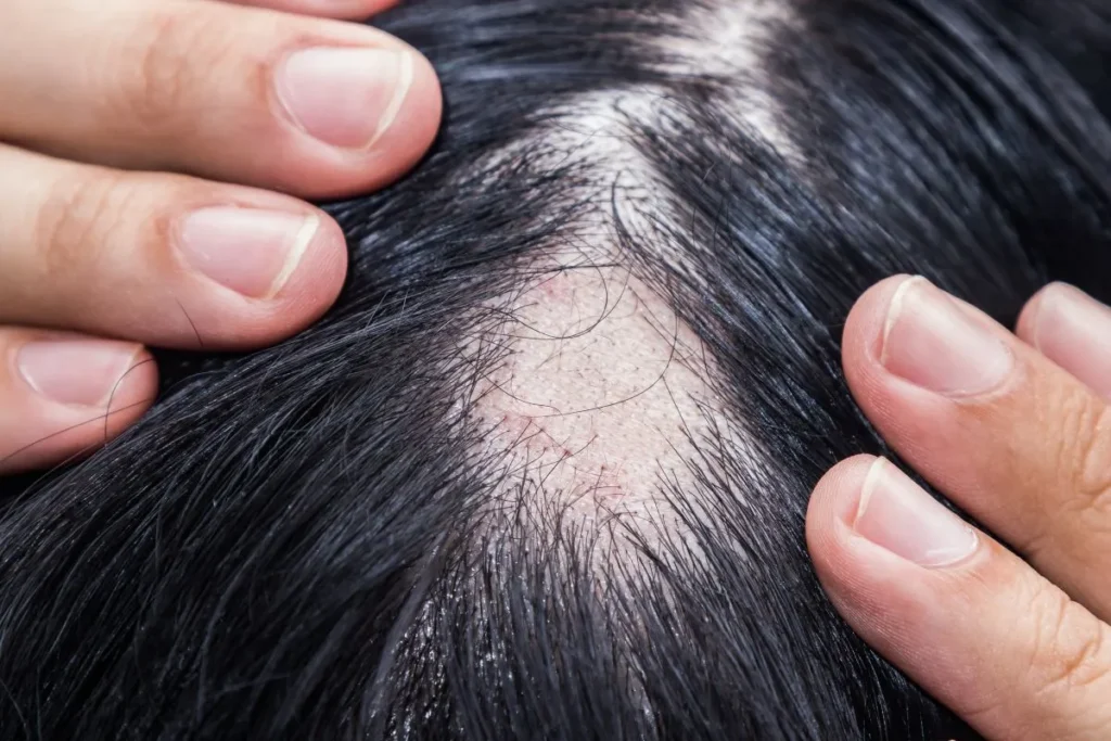 Understanding Alopecia in Kids