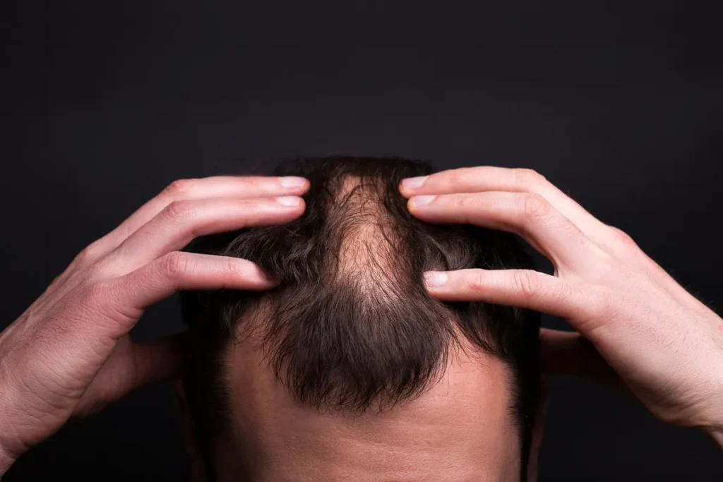 Effective Relief Strategies for Alopecia Scalp Pain