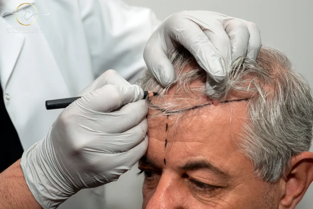 Understanding Different Types of Alopecia