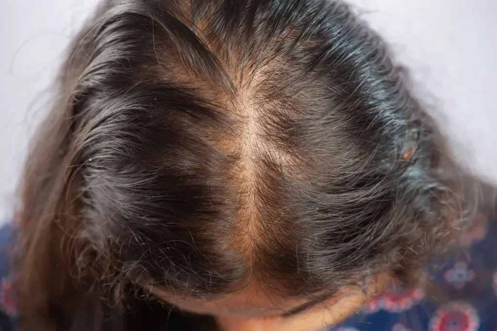 Early Warning Signs in Alopecia Teenager Cases