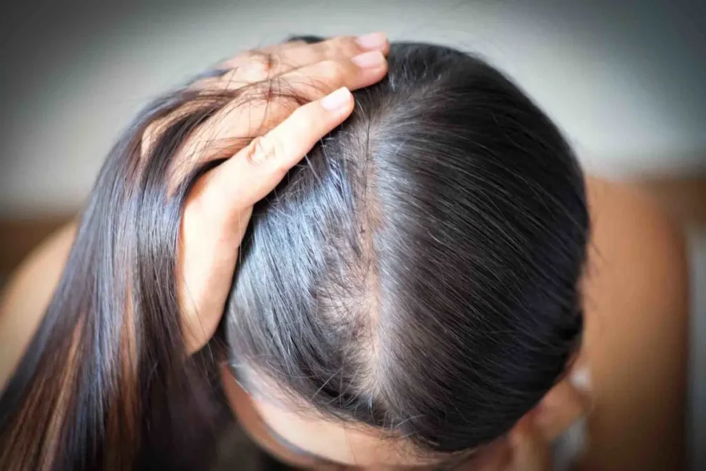 Understanding Female Pattern Hair Loss