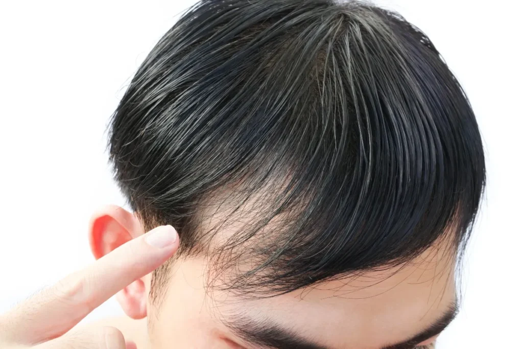 Characteristics of a Normal Hairline
