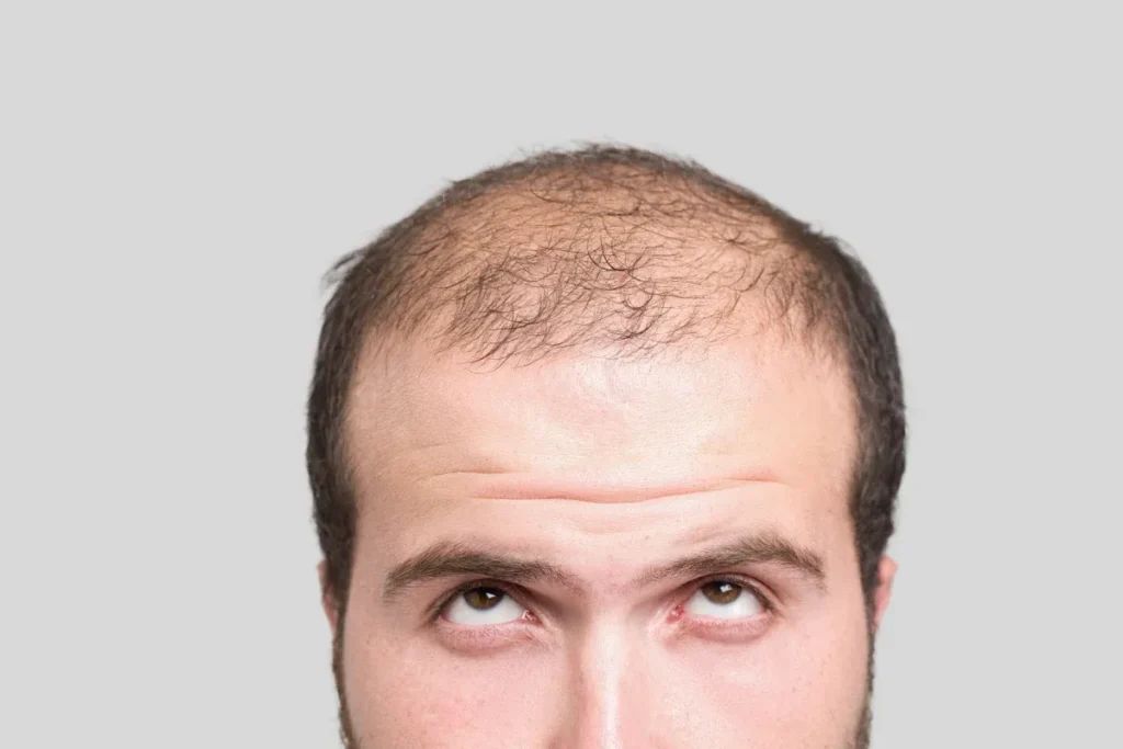 Avoid Male Pattern Baldness: Best Hacks