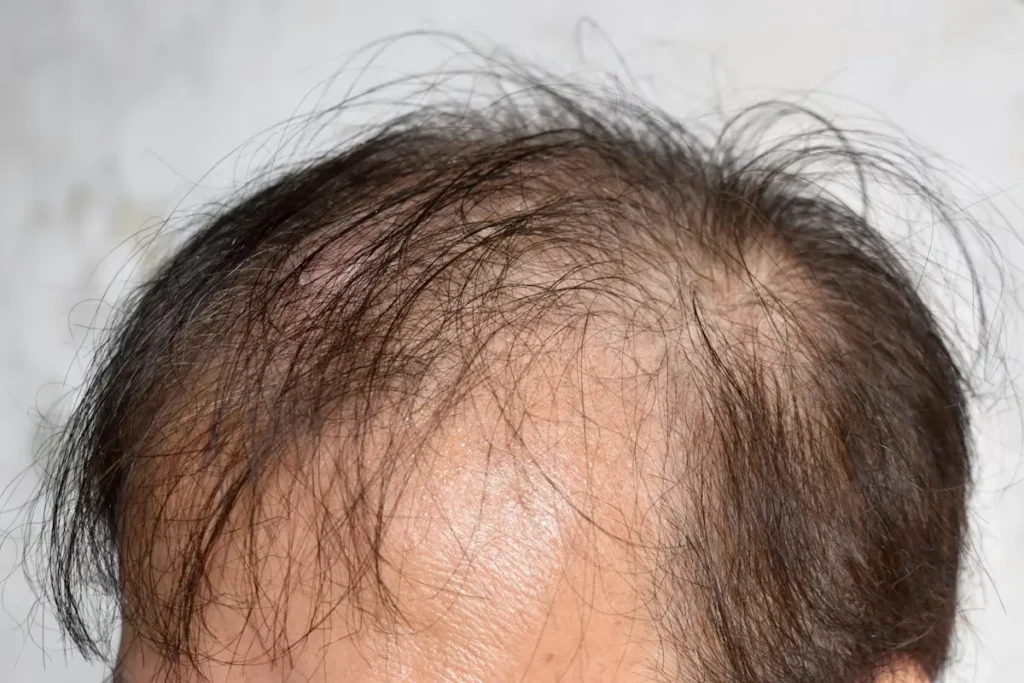 Understanding Male Pattern Baldness