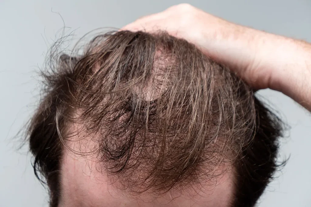 B6 And Hair Loss: Best Vitamin Secrets
