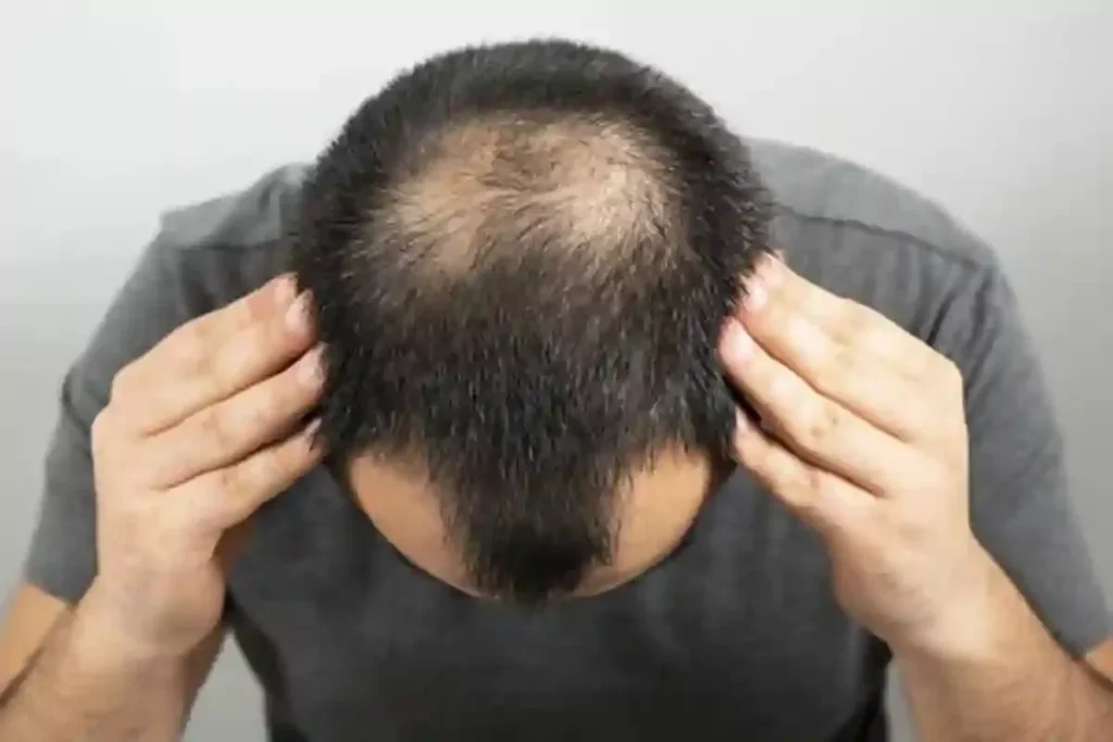 Understanding Back of Head Hairline Female Pattern Loss
