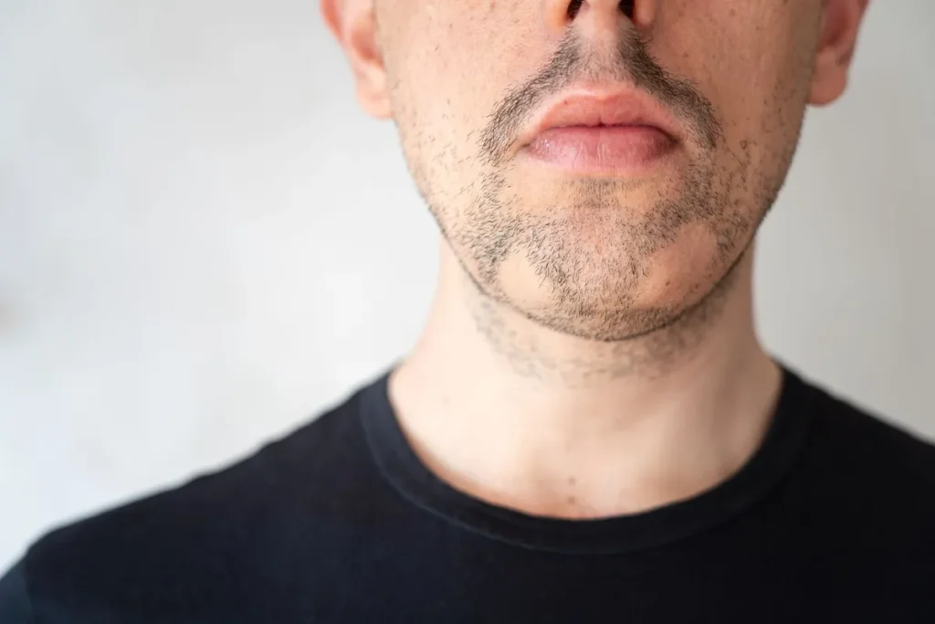 Bald Spot In Beard: Powerful Fixes Today