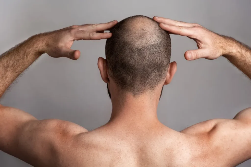 Understanding Bald Spots on Top of Head
