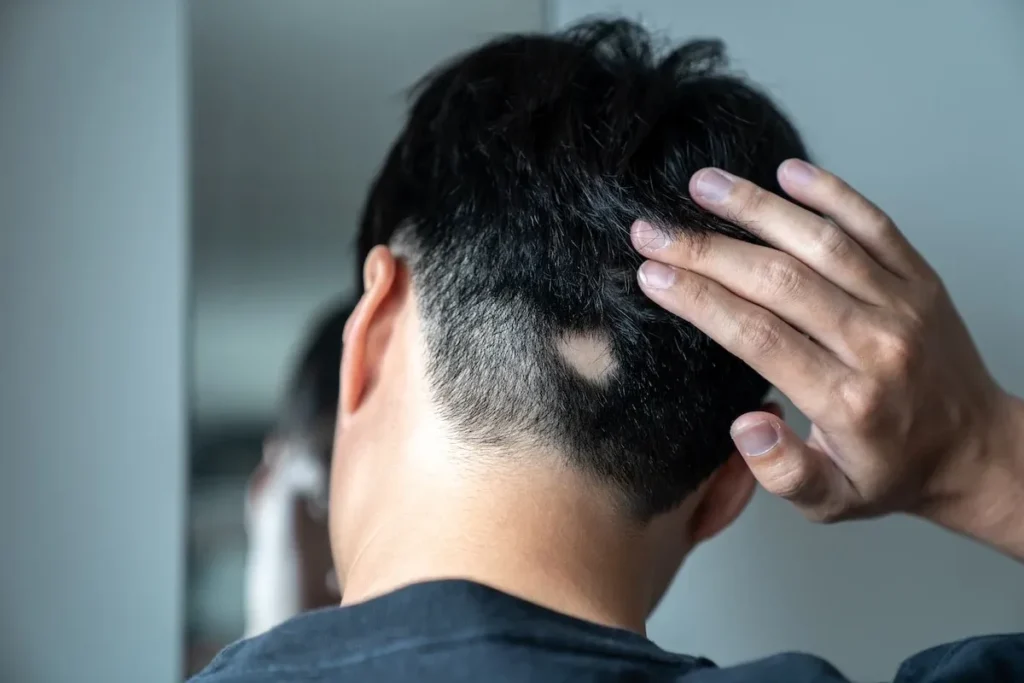Medical Treatments for Bald Spot on Top of Head