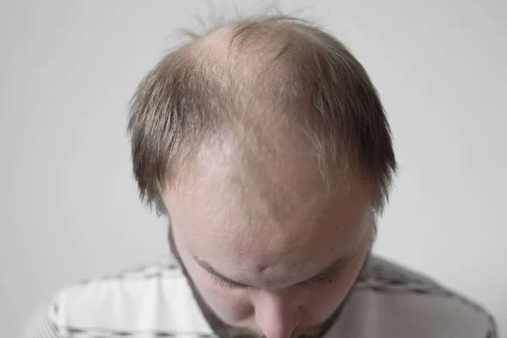 Bald Young Men: Best Grooming Secrets