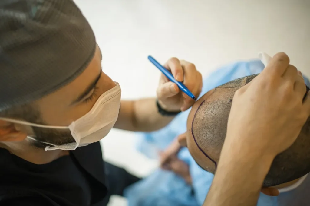 Fue Donor Area After 2 Weeks: Fast Tips