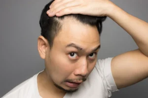 Typical donor zones on the scalp