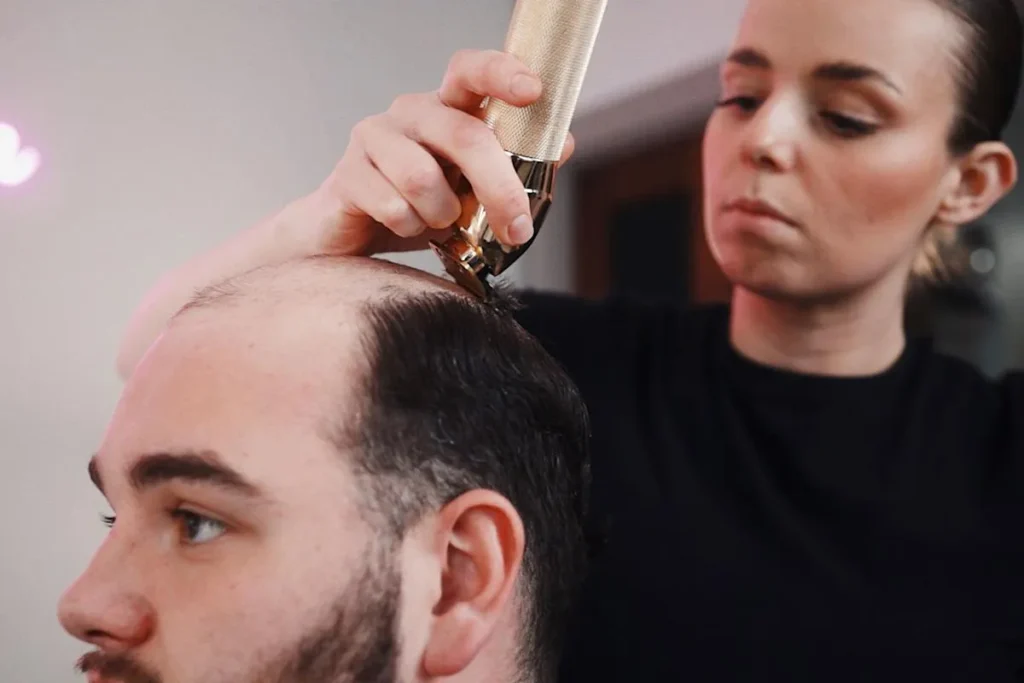 Understanding Balding at 20 Male: Causes and Prevalence