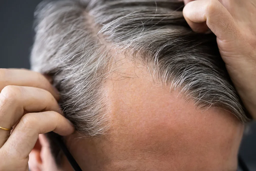 Balding On One Side Of Head: Best Fixes