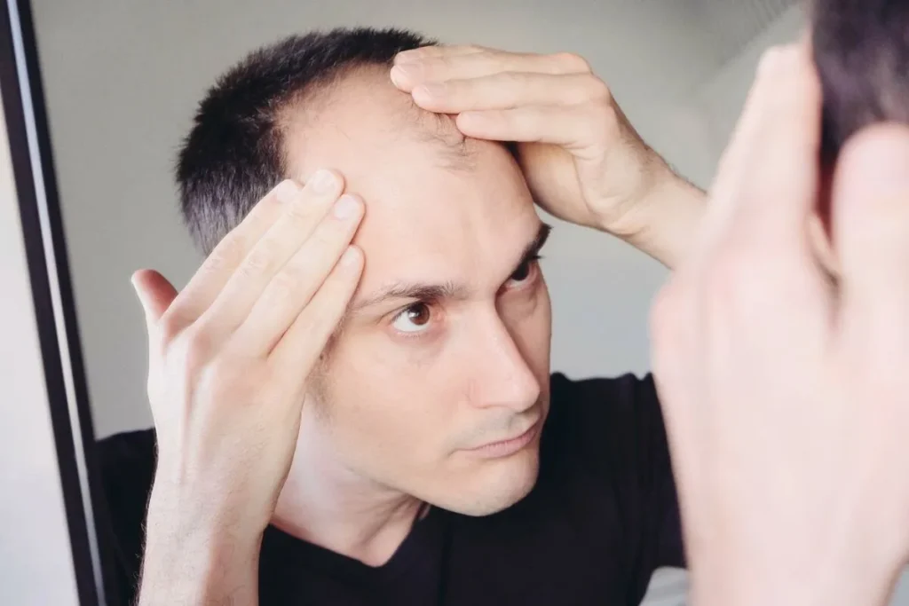 Balding On Top Of Head: Ultimate Cures