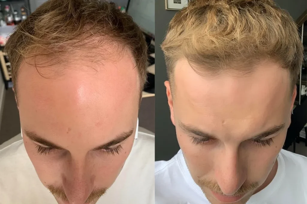 Balding Or Receding Hairline: Easy Test