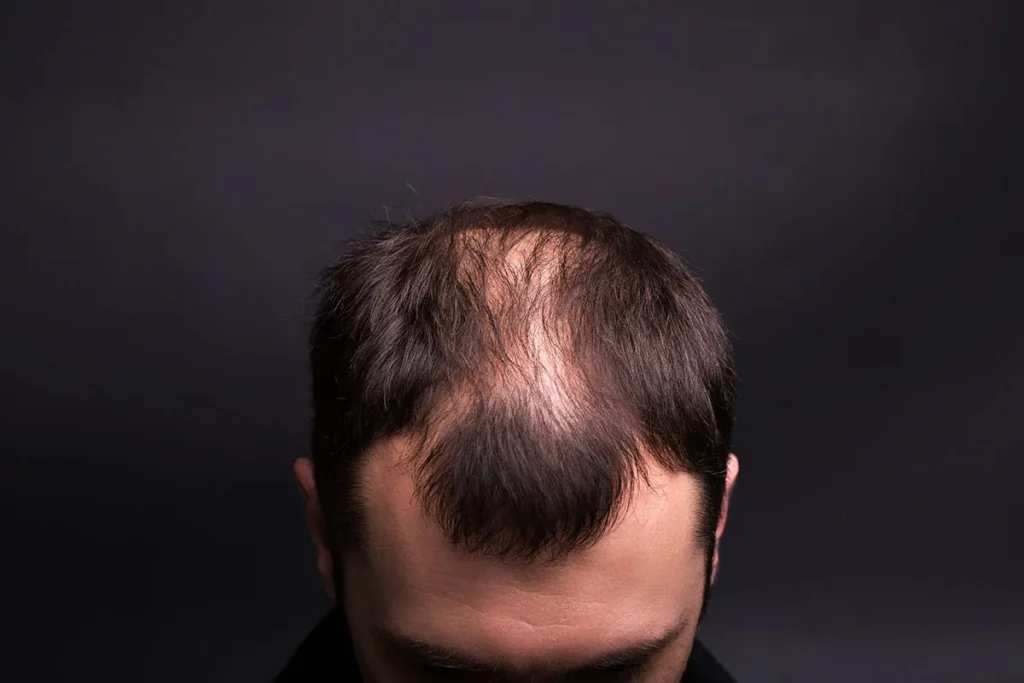 Balding Scalp Pain: Best Relief Methods
