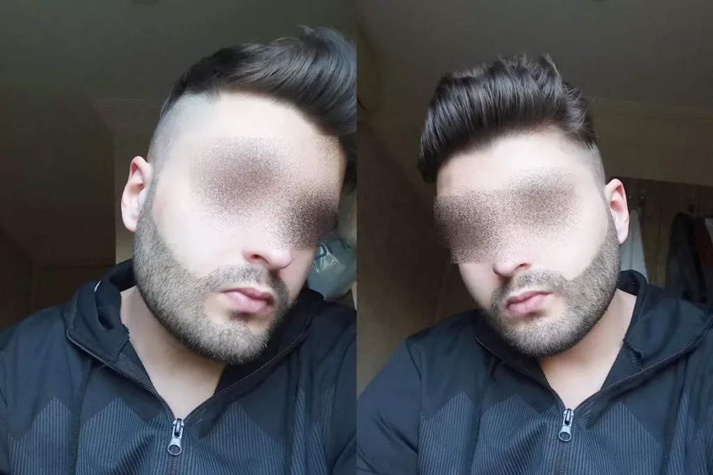 Understanding Beard Transplants