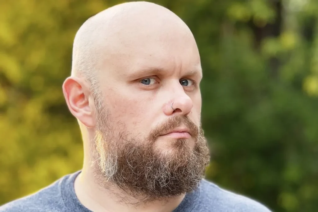 Beard Transplant Timeline: Best Growth Guide