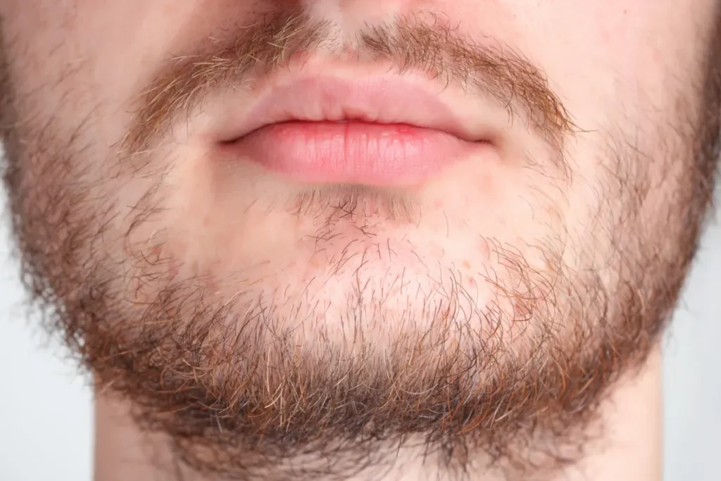 The Beard Transplant Timeline: Growth Phases (Months 1-12)