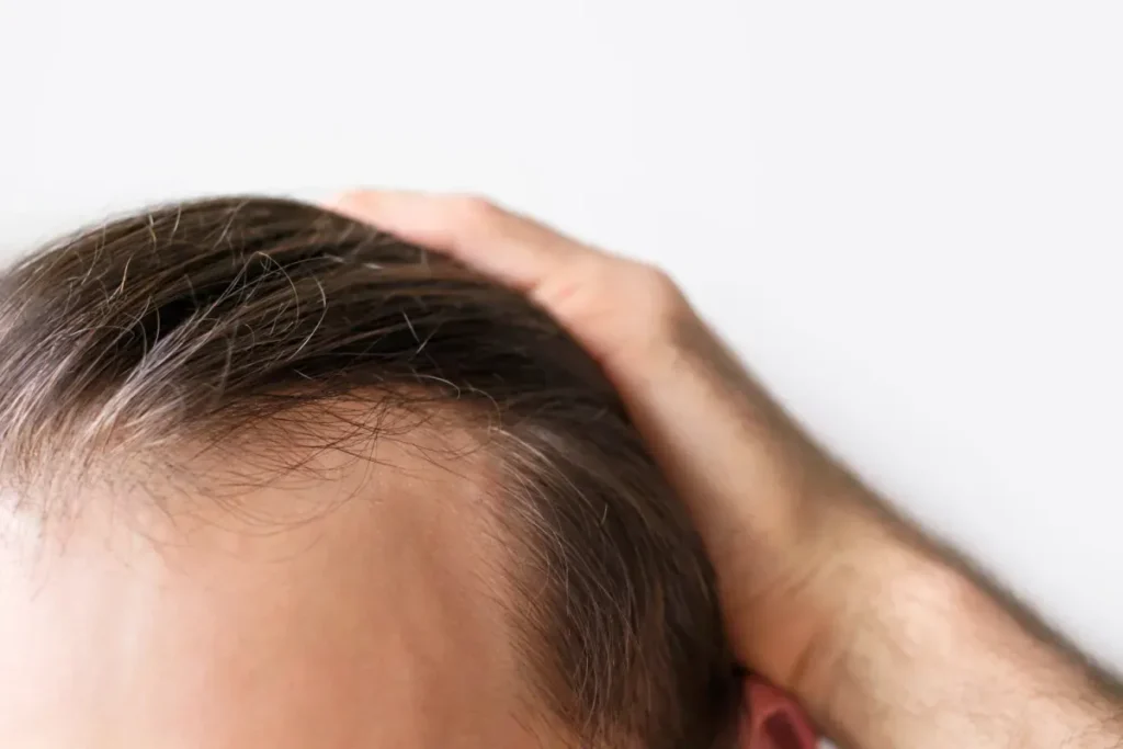 Can A Dermatologist Help With Hair Loss? Yes