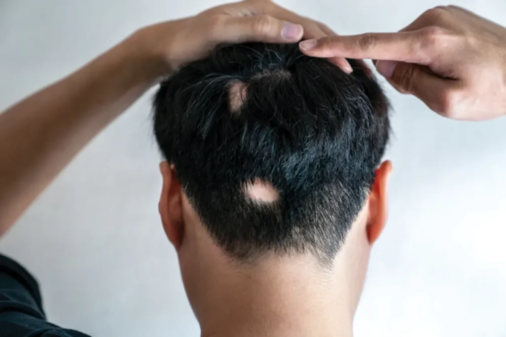 The Connection Between Mental Health and Hair Loss