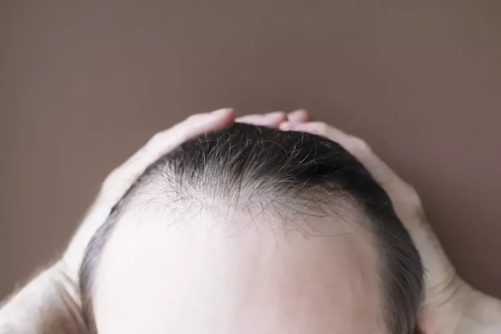 Can Folic Acid Help With Hair Loss? Results