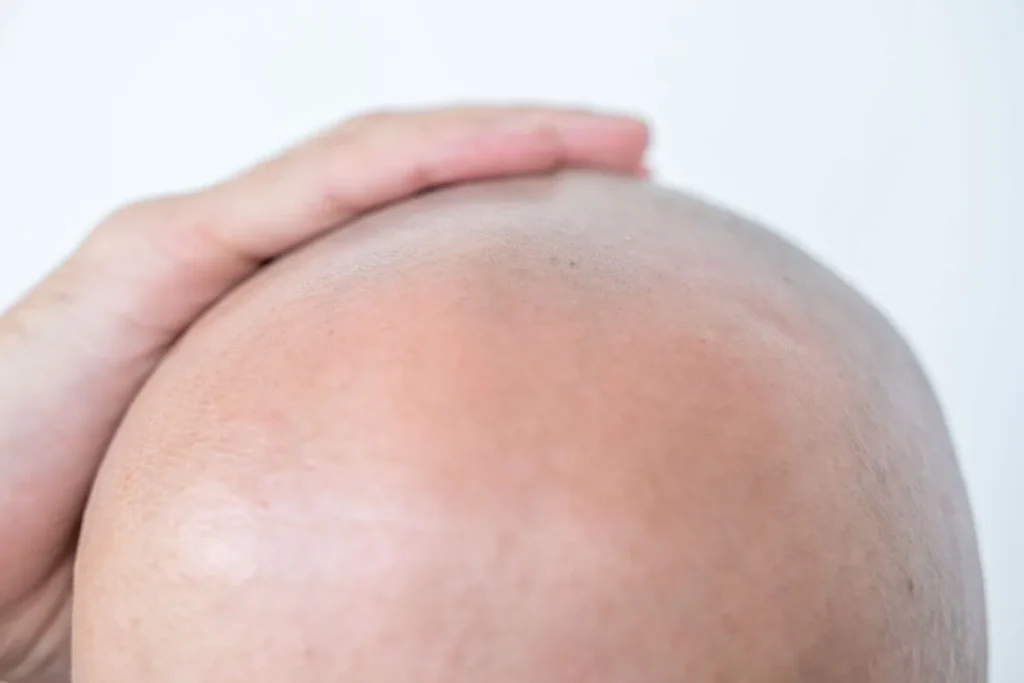 Can Menopause Cause Hair Loss? Best Relief