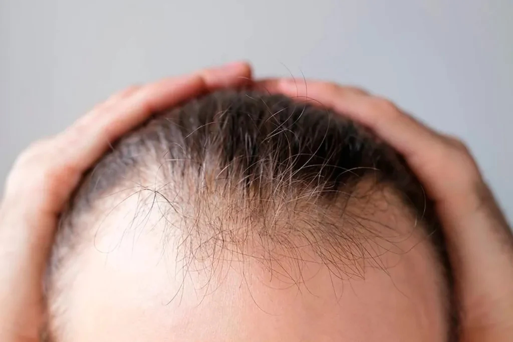 Can Prp Regrow Hair? Amazing Success Tips