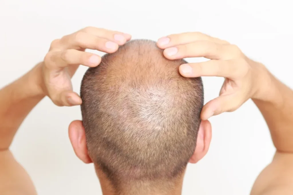 Can Someone With Alopecia Get A Hair Transplant?