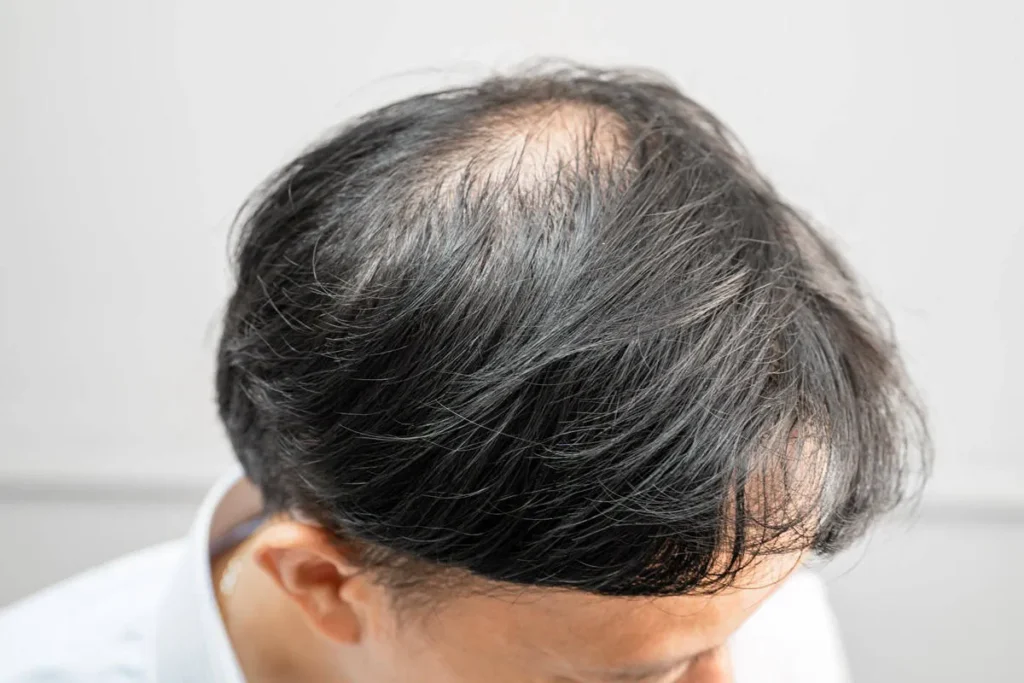 Can Stress Cause Bald Spots? Fast Recovery