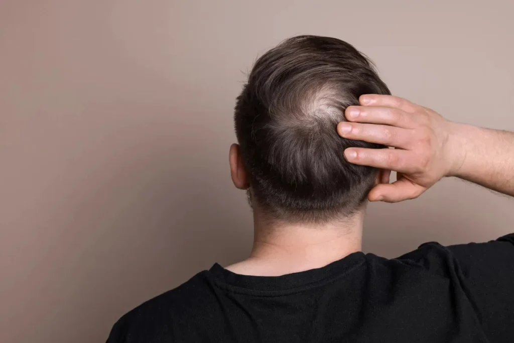 Can Stress Cause Bald Spots? Fast Recovery